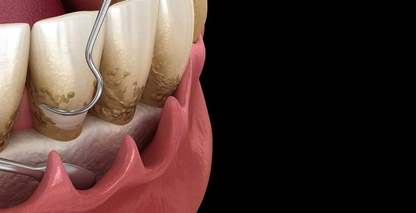 dental-curettage-deep-cleaning