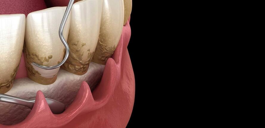 dental-curettage-deep-cleaning