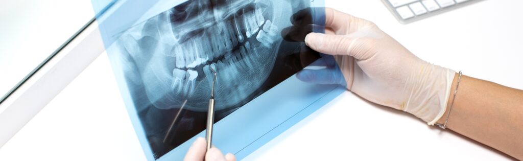 Dental-Fillings