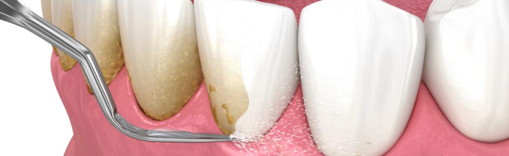 Dental-Scaling
