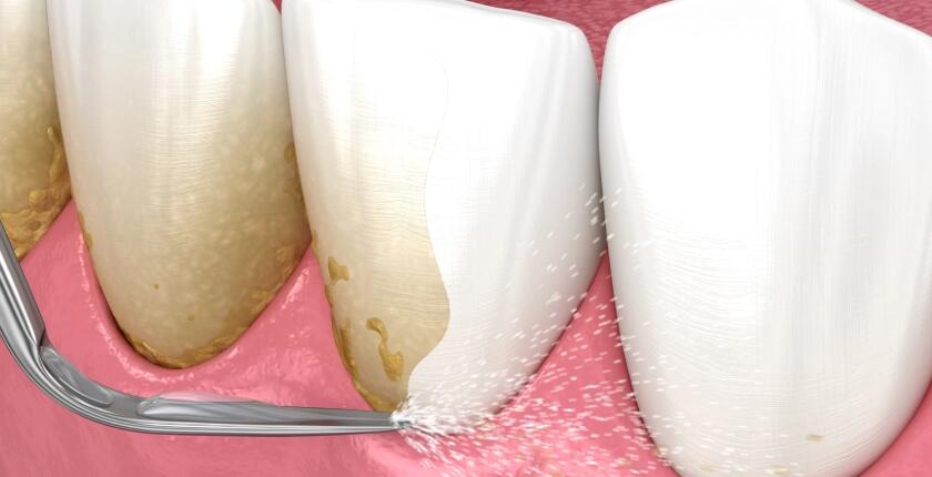 Dental-Scaling