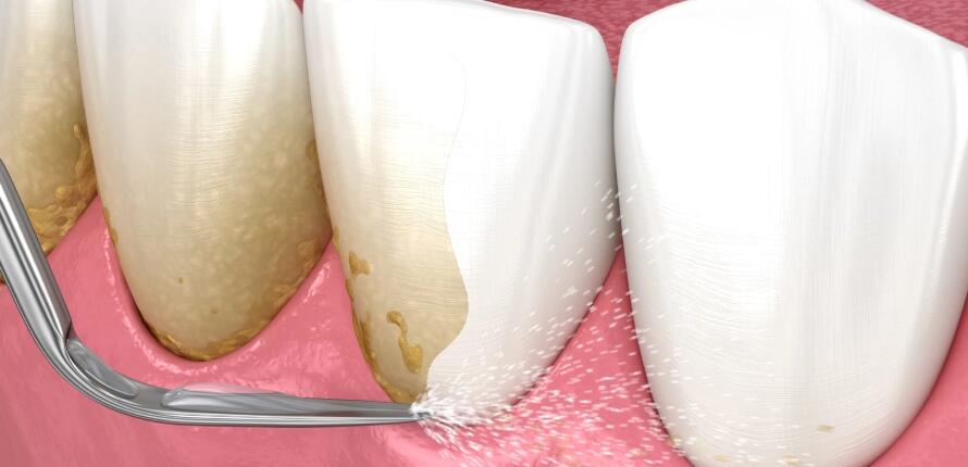 Dental-Scaling