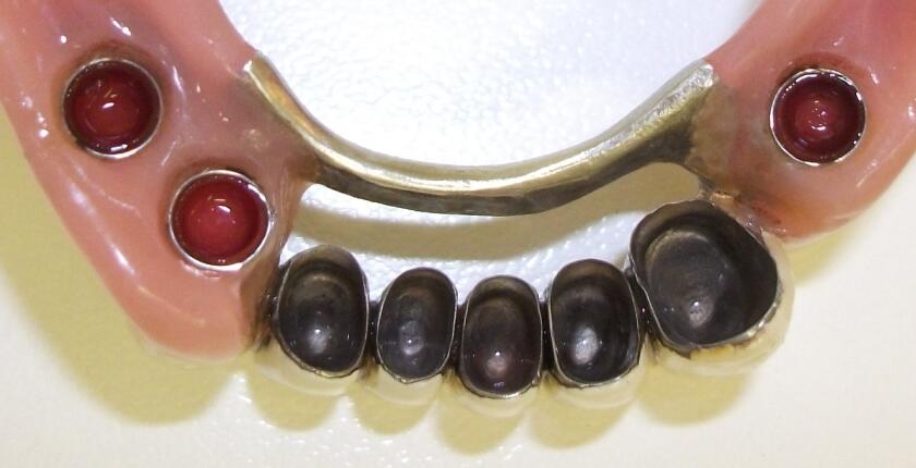 Fixed-removable-dentures