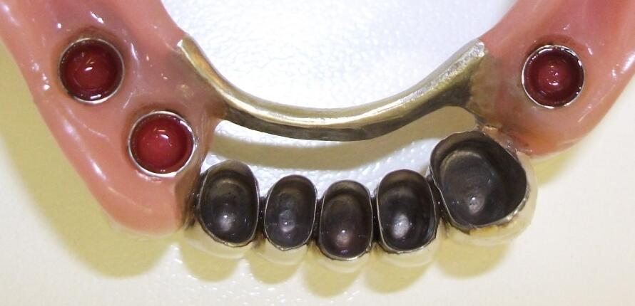 Fixed-removable-dentures