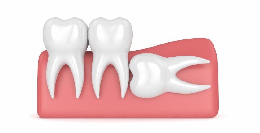 Impacted-Tooth-Extraction