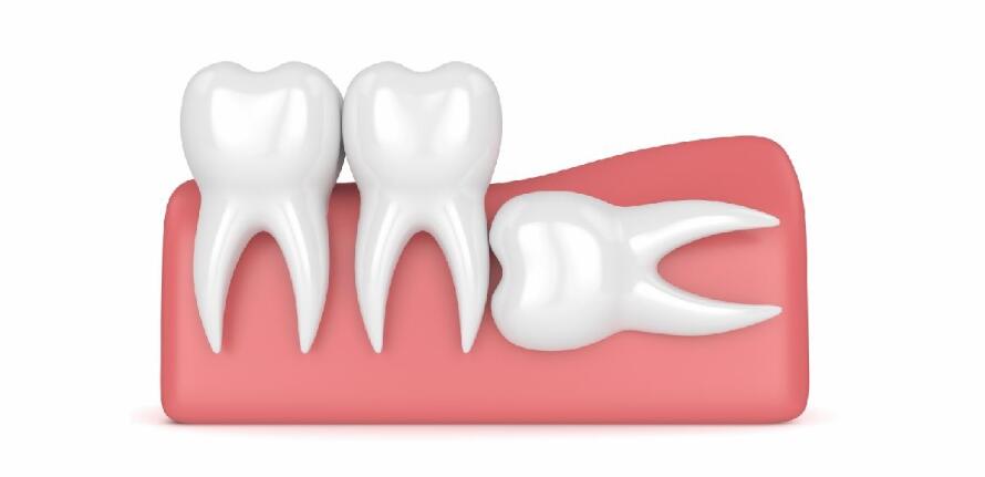 Impacted-Tooth-Extraction