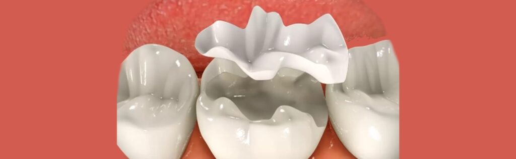 Inlay-Fillings