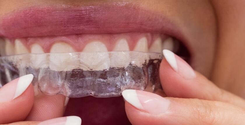 Invisalign-Treatment