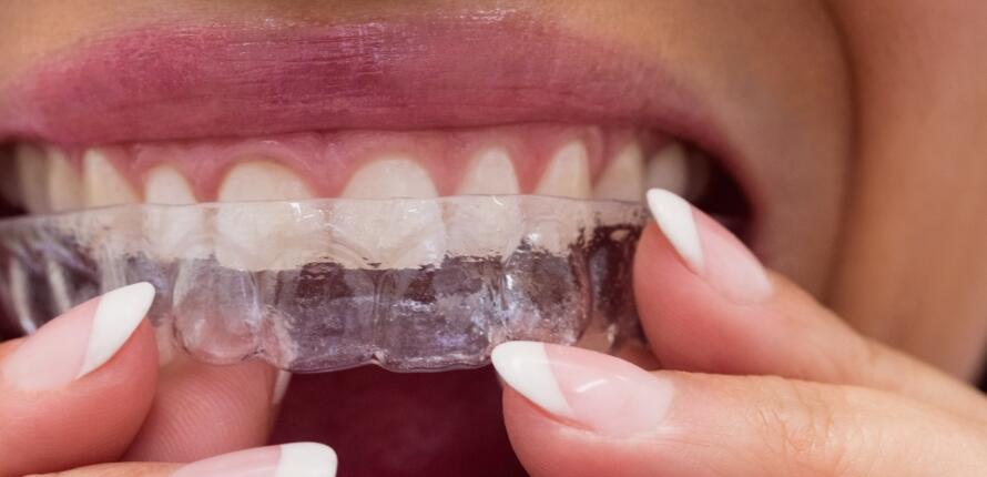 Invisalign-Treatment