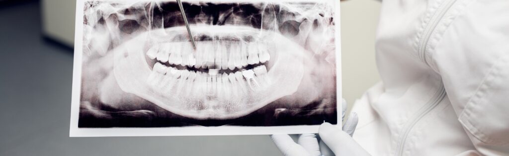 Tooth-Extraction