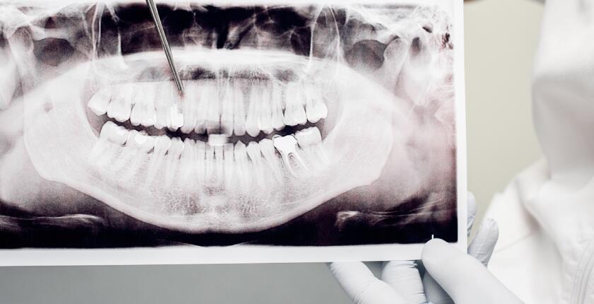 Tooth-Extraction