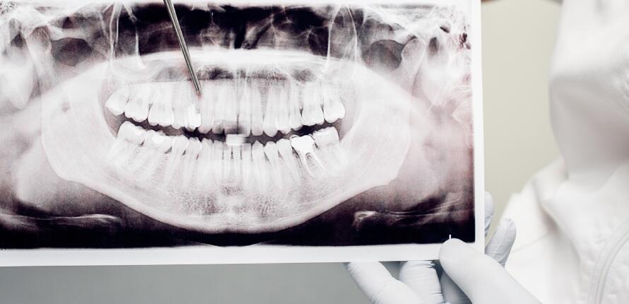 Tooth-Extraction