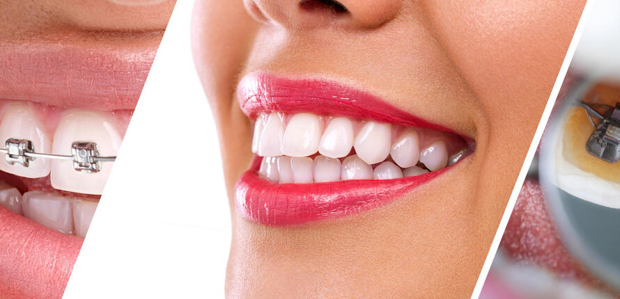 Treatment-for-Crooked-Teeth