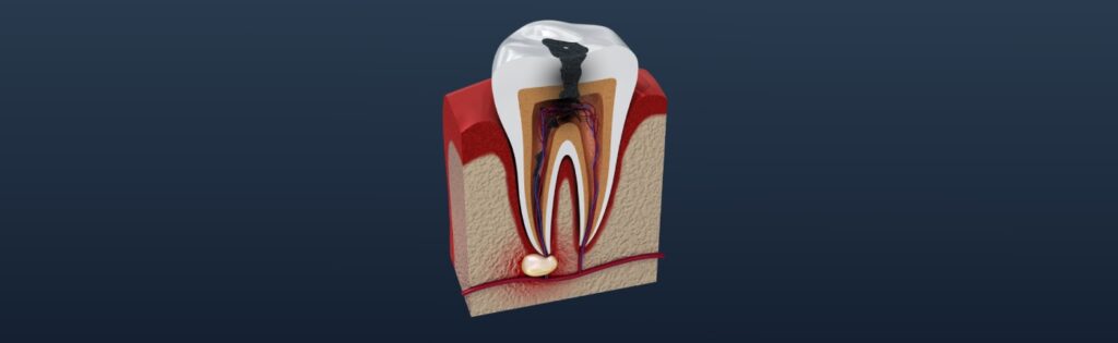 Treatment-for-Dental-Abscesses