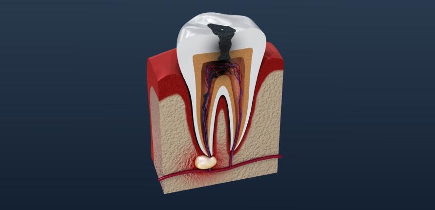 Treatment-for-Dental-Abscesses