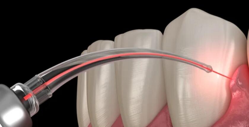 Treatment-for-Gingival-Recession