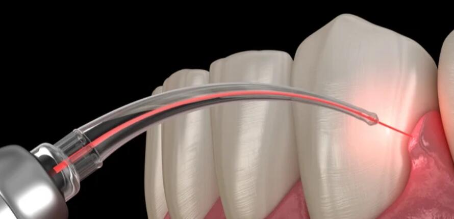 Treatment-for-Gingival-Recession