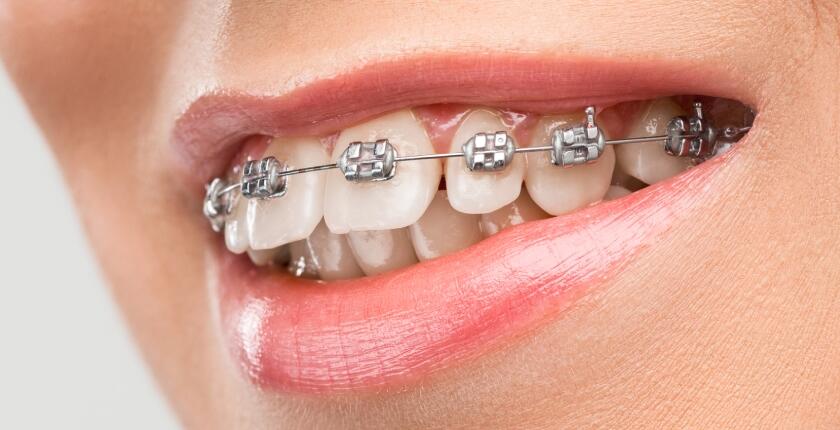 Treatment-with-Dental-Braces