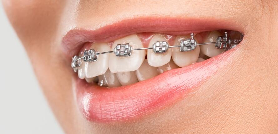 Treatment-with-Dental-Braces