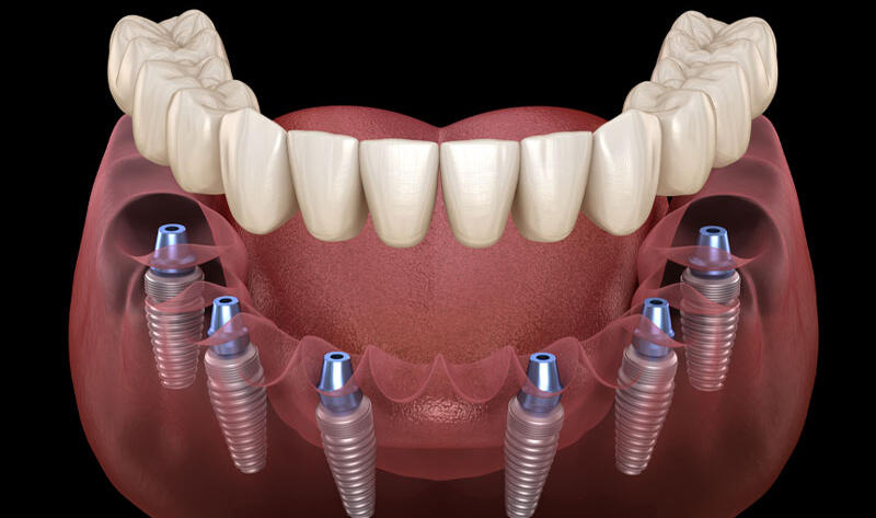 Complete-Mouth-Dentures