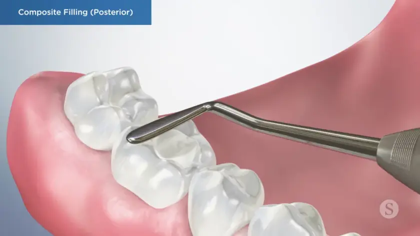 Cosmetic-Dental-Fillings