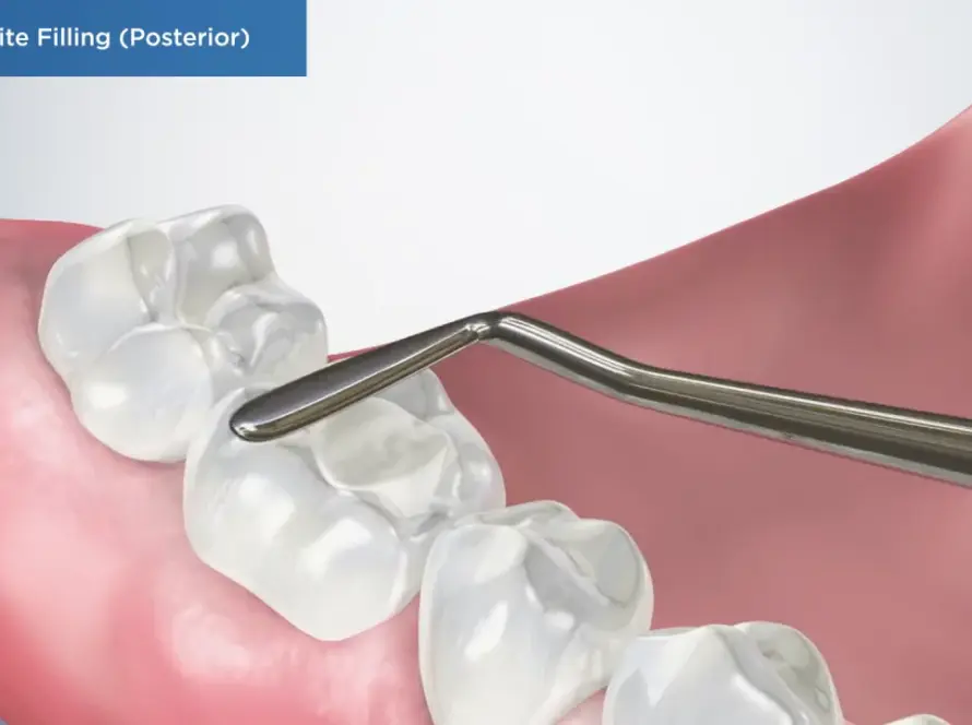 Cosmetic-Dental-Fillings