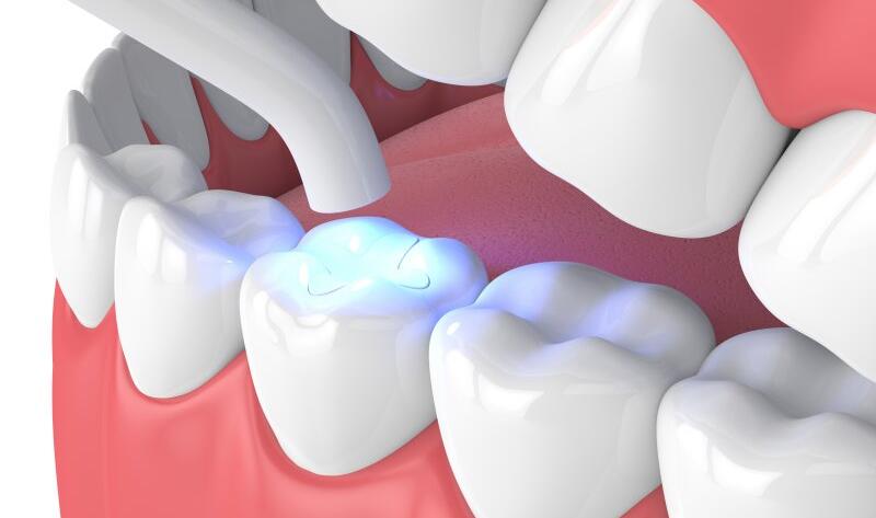 How-Long-does-Dental-Filling-last