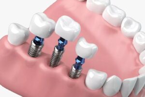 Comparison between All on 6 vs All on 4 dental implants.