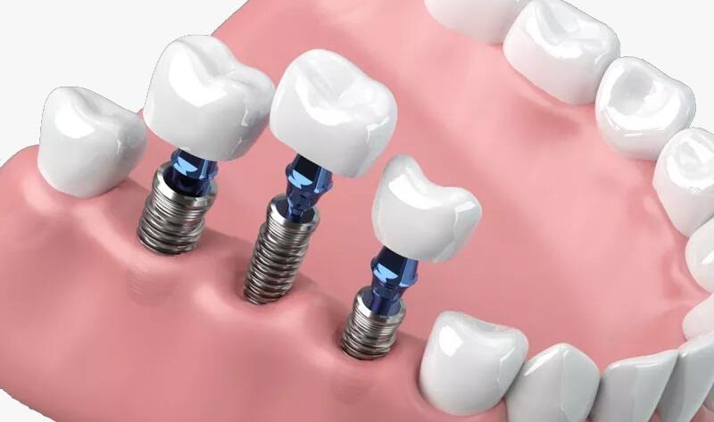 Comparison between All on 6 vs All on 4 dental implants.