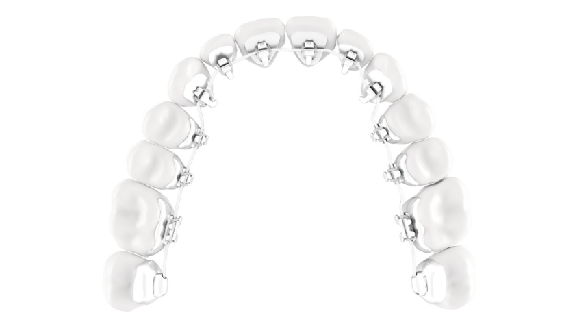 Lingual-Braces-Treatment