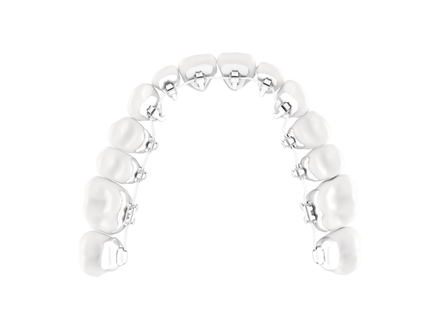 Lingual-Braces-Treatment