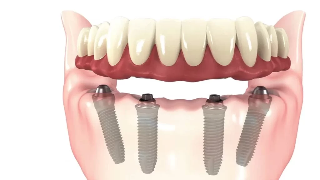 What-are-All-On-4-Dental-Implants