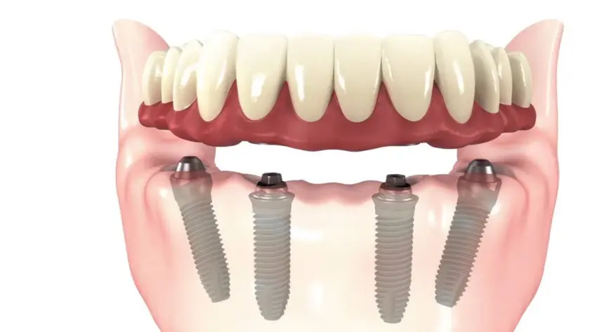 What-are-All-On-4-Dental-Implants