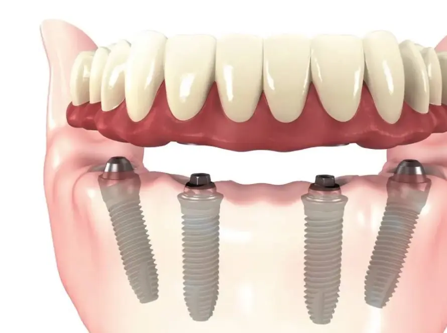 What-are-All-On-4-Dental-Implants