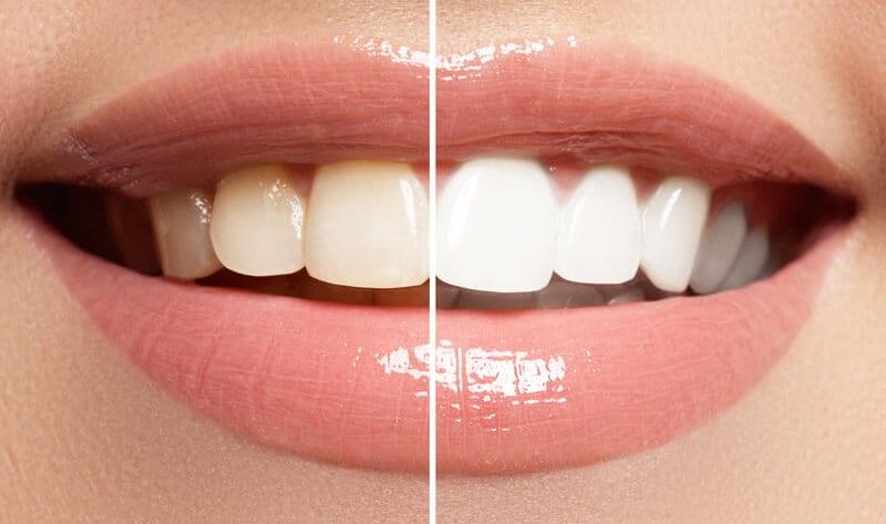 What-are-Teeth-Whitening-Methods