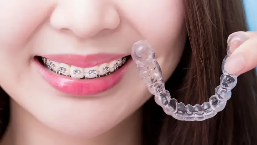 What-are-the-Types-of-Braces