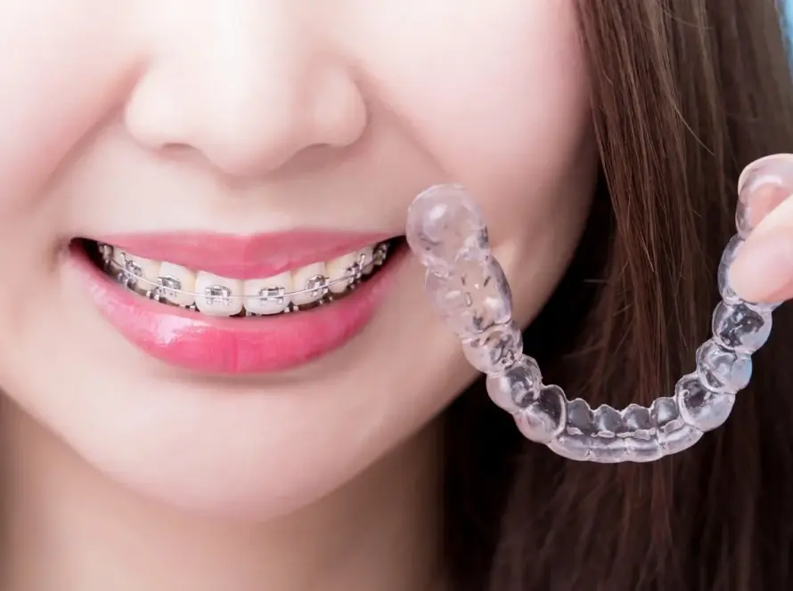 What-are-the-Types-of-Braces