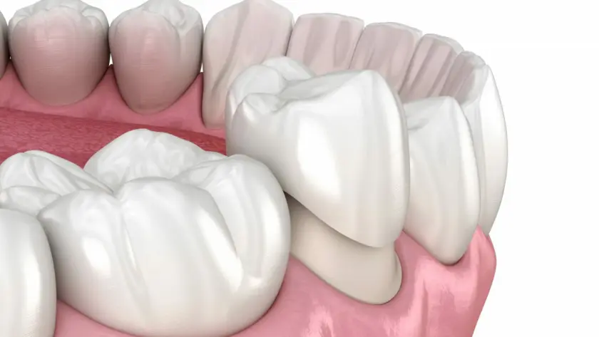 What-are-Zirconia-and-Porcelain-Veneers