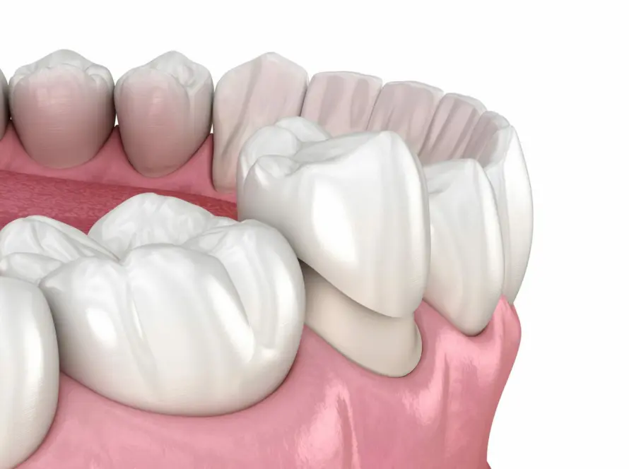 What-are-Zirconia-and-Porcelain-Veneers