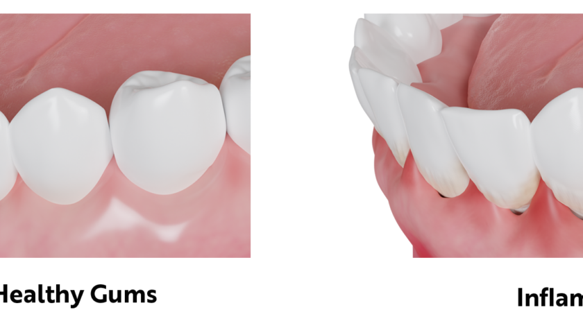 What-Causes-Gum-Diseases