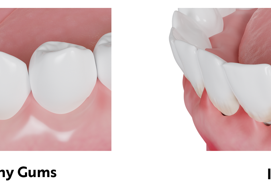 What-Causes-Gum-Diseases