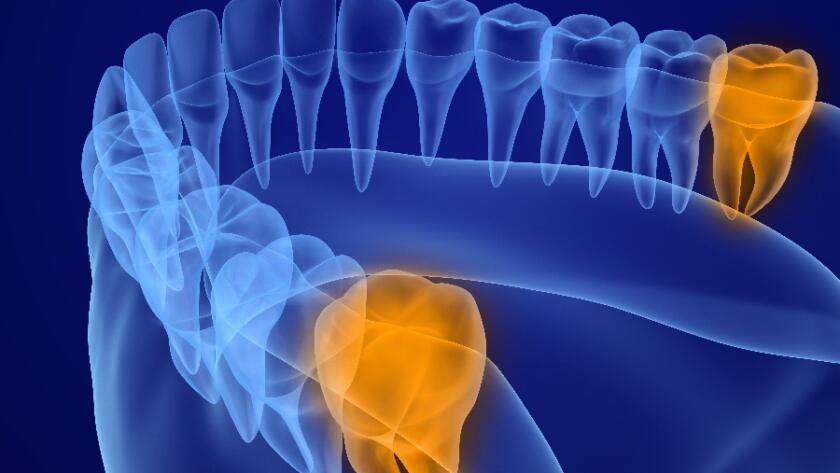 What-is-a-wisdom-tooth