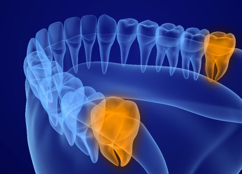 What-is-a-wisdom-tooth