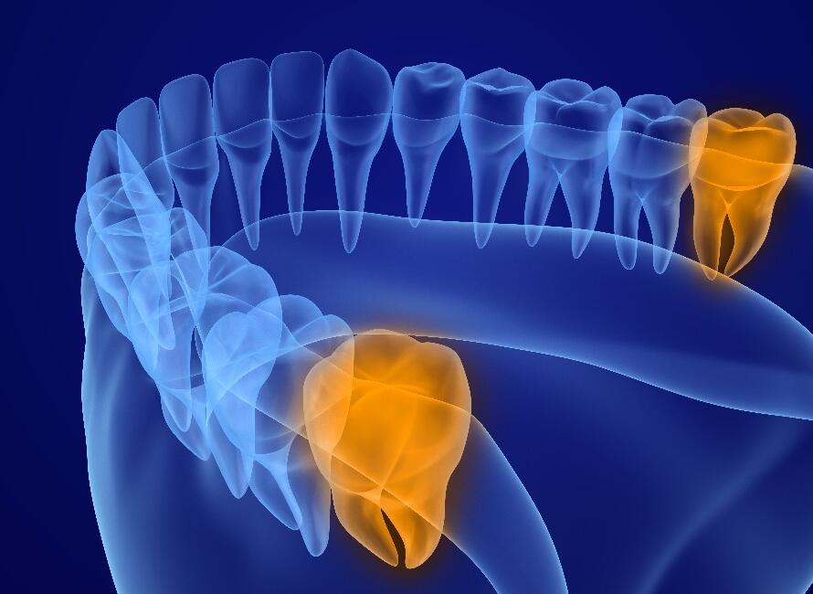 What-is-a-wisdom-tooth