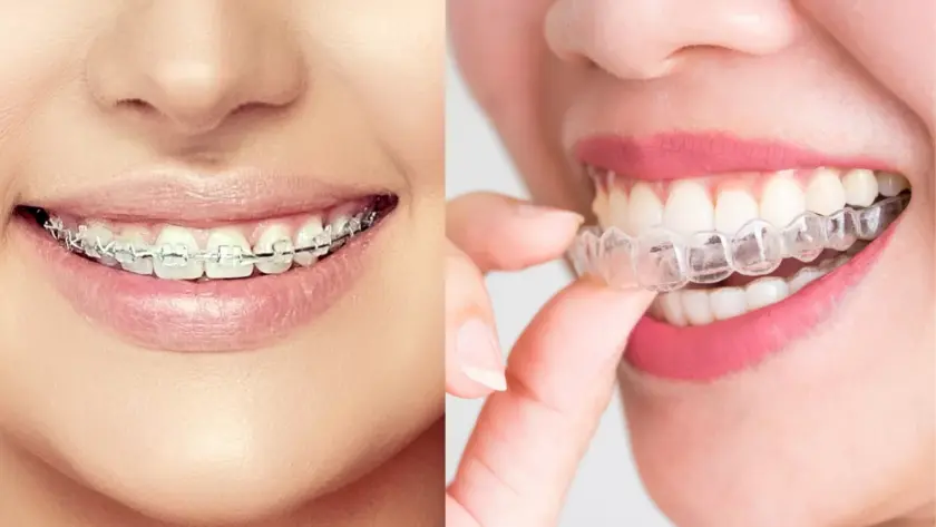 What-is-Clear-Aligner-Therapy