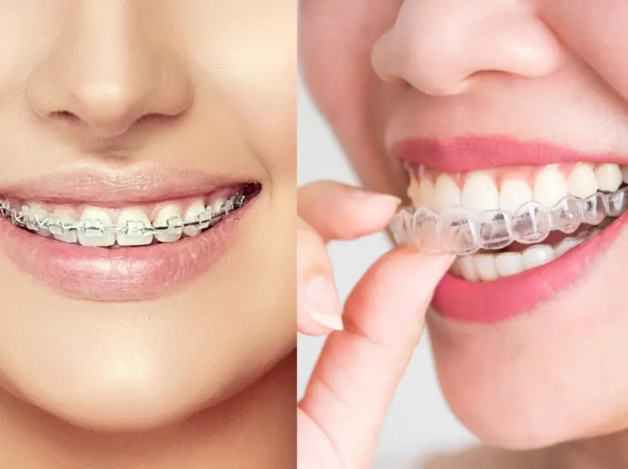 What-is-Clear-Aligner-Therapy