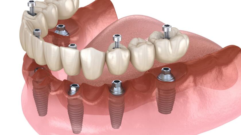 What-is-Complete-Mouth-Dental-Implant-Treatment