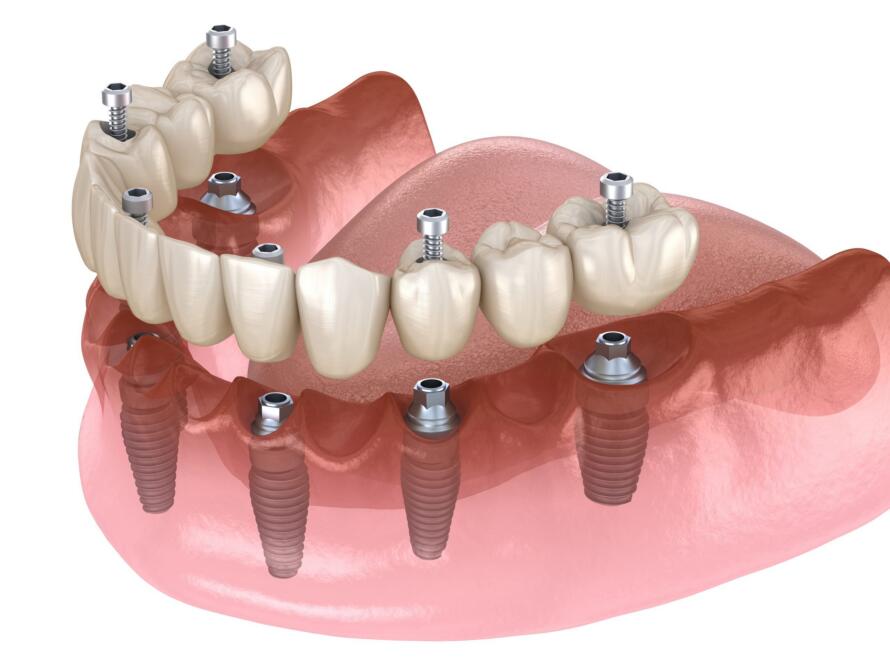 What-is-Complete-Mouth-Dental-Implant-Treatment