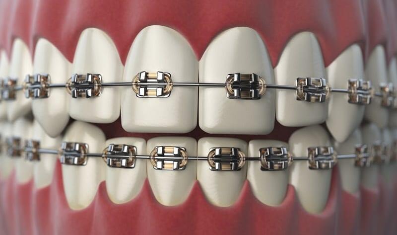 What-is-dental-braces-treatment