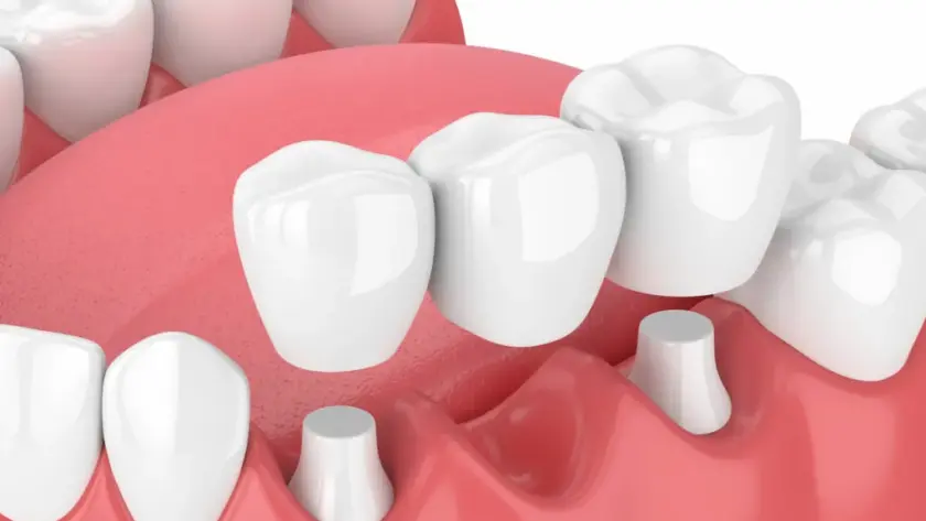 What-is-Dental-Bridge